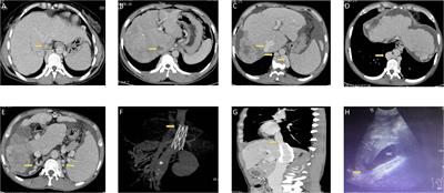 Budd-Chiari syndrome and its associated hepatocellular carcinoma: Clinical risk factors and potential immunotherapeutic benefit analysis